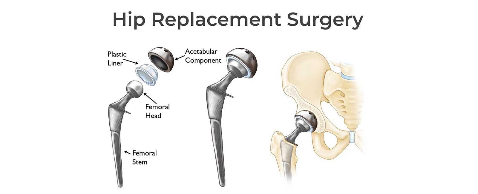Hip Replacement