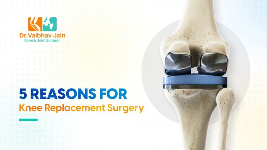 5 Reasons For Knee Replacement Surgery