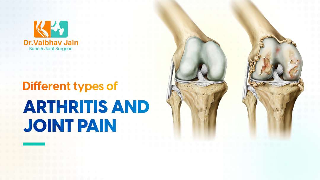 Arthritis and Joint Pain: Exploring Different Types and Management