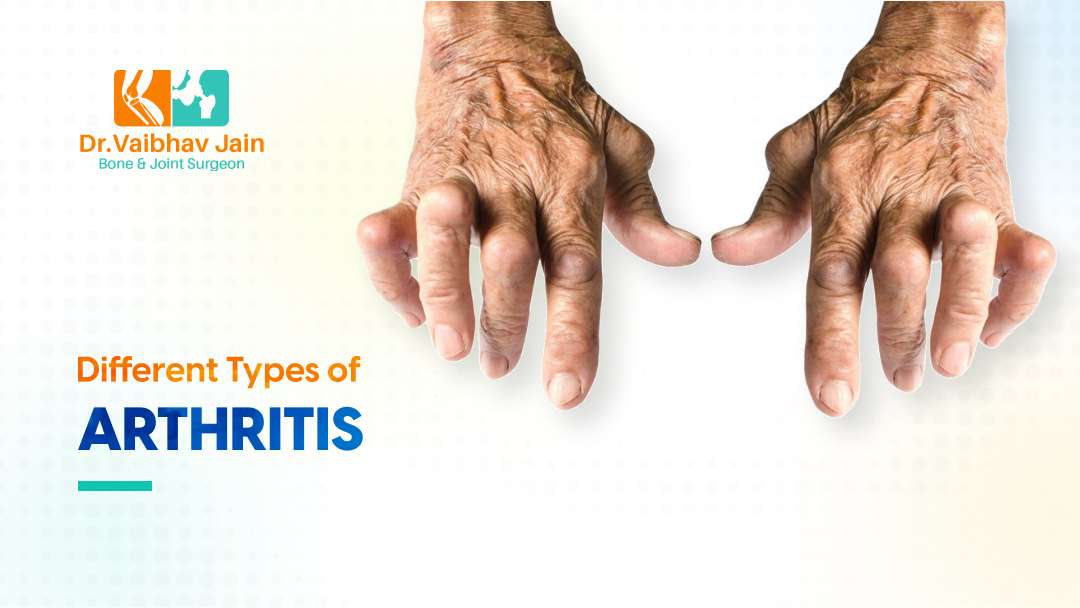 Arthritis In The Hand And Wrist Symptoms, Types & Treatments Dr. Vaibhav Jain