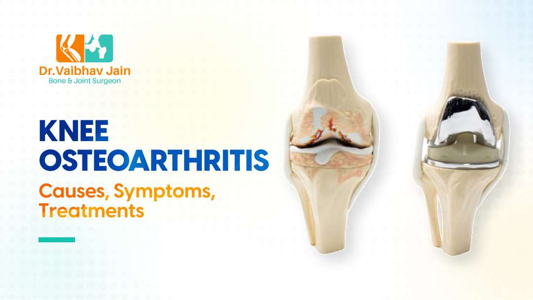 Knee Osteoarthritis Causes, Symptoms, Treatments – Dr. Vaibhav Jain