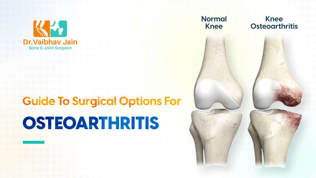 Orthopedic Doctor – Guide To Surgical Options For Osteoarthritis Dr. Vaibhav Jain