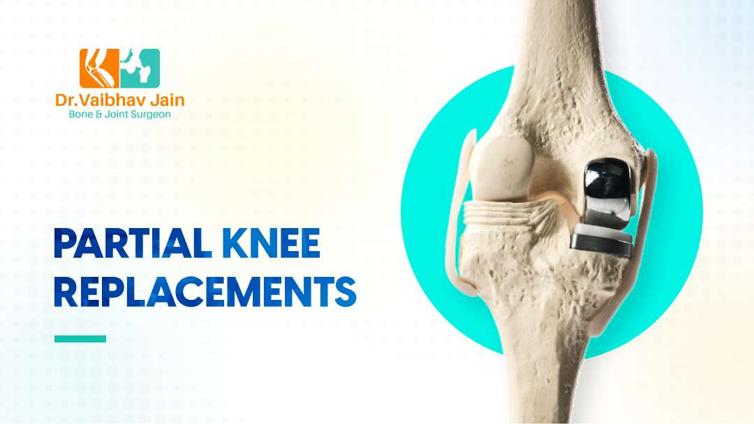 What Is A Partial Knee Replacement