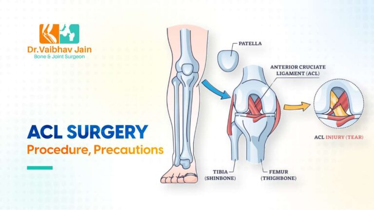 What precautions should be taken after ACL surgery?