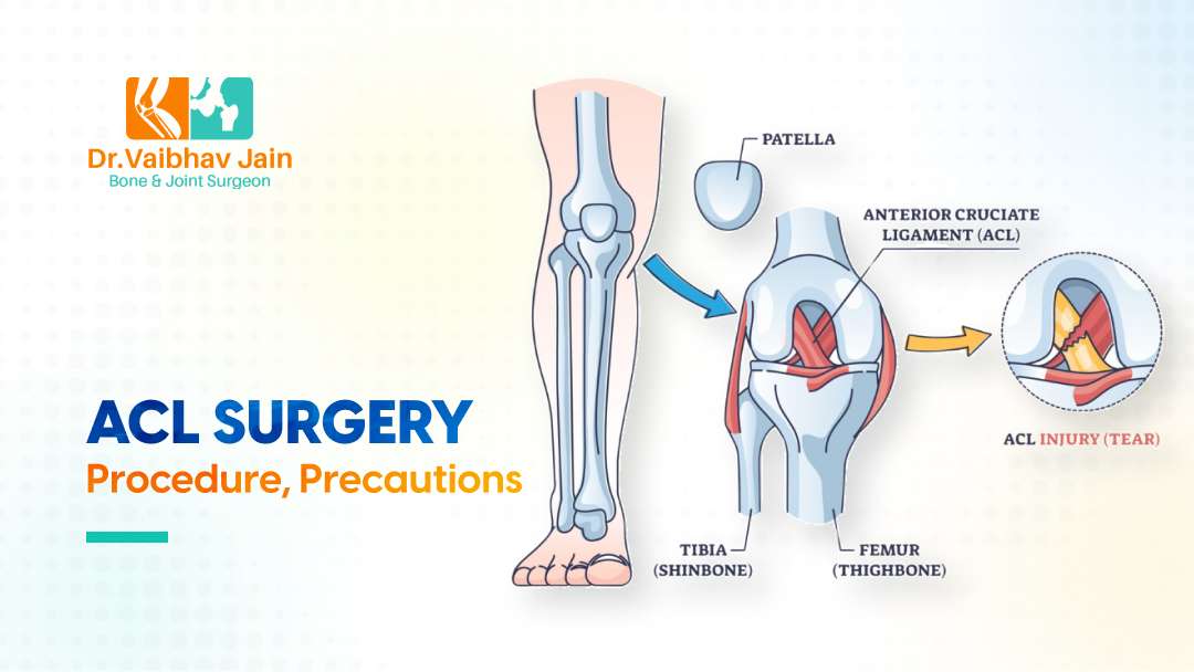 What Is ACL Surgery What Precautions Should Be Taken After ACL Surgery
