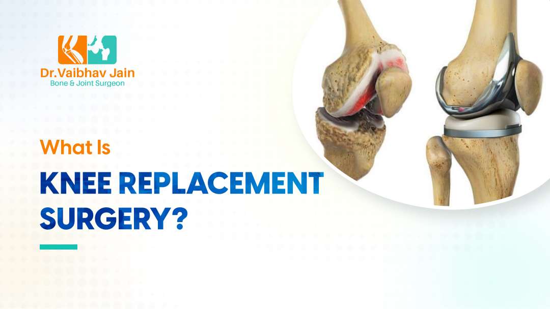 What Is Knee Replacement Surgery?