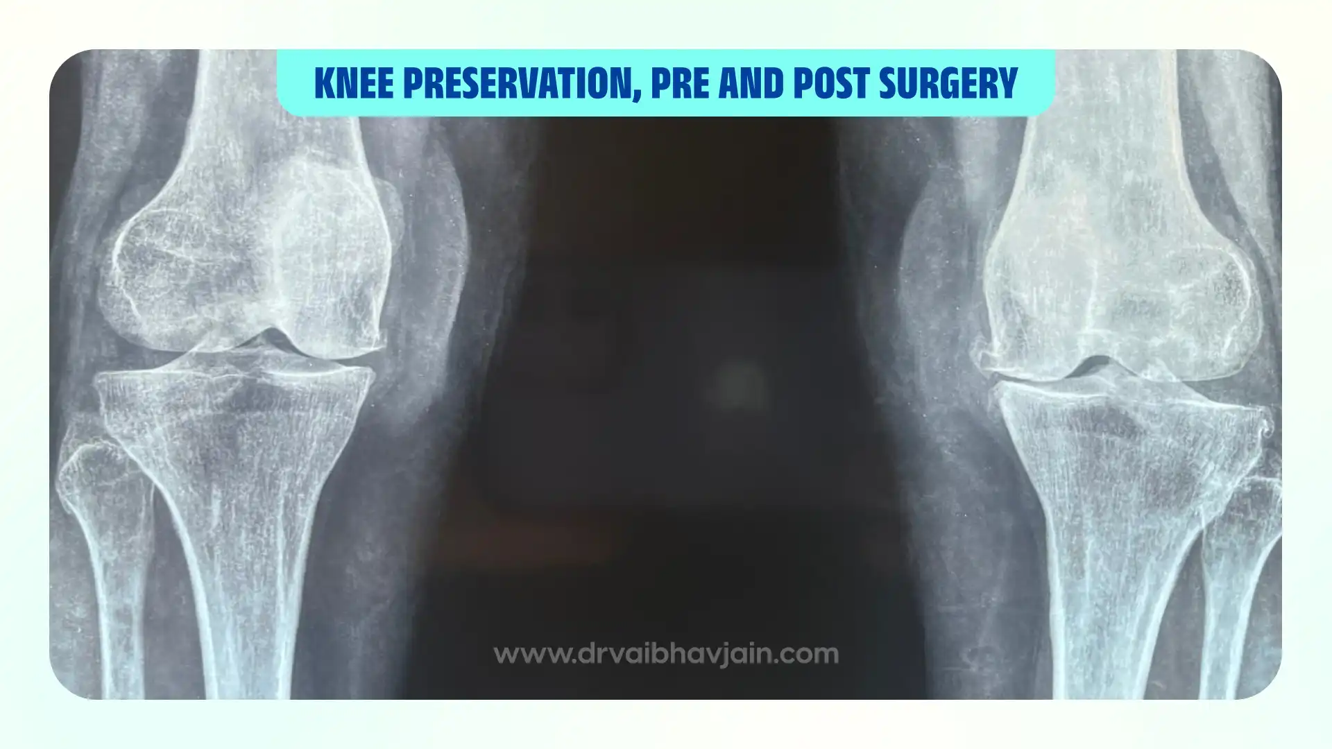 Knee Joint Preservation Techniques, pre and post surgery