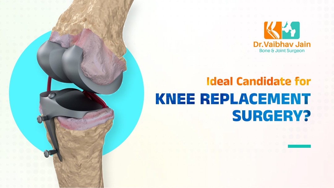 Candidate for Knee Replacement Surgery