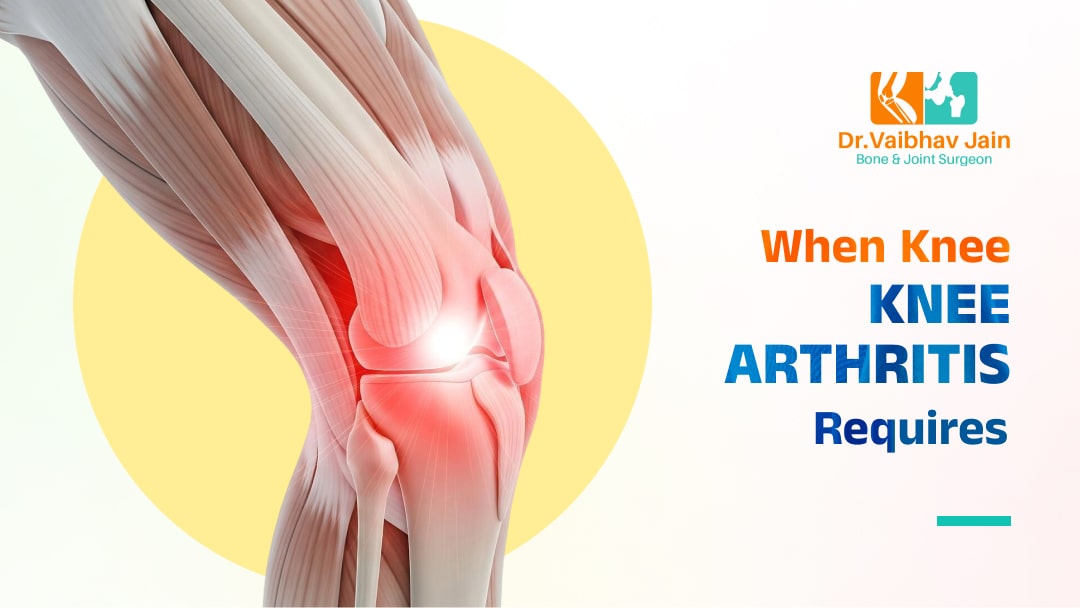 When Knee Arthritis Requires Knee Replacement Surgery